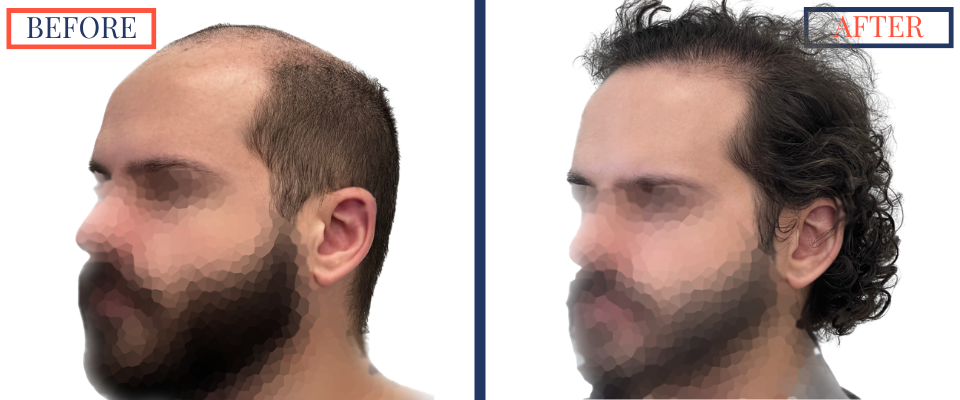 2623 graft FUE hair transplant results