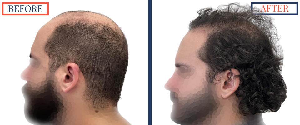 2623 graft FUE hair transplant results