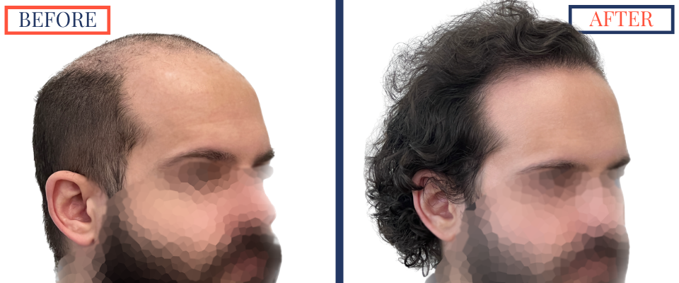 2623 graft FUE hair transplant results