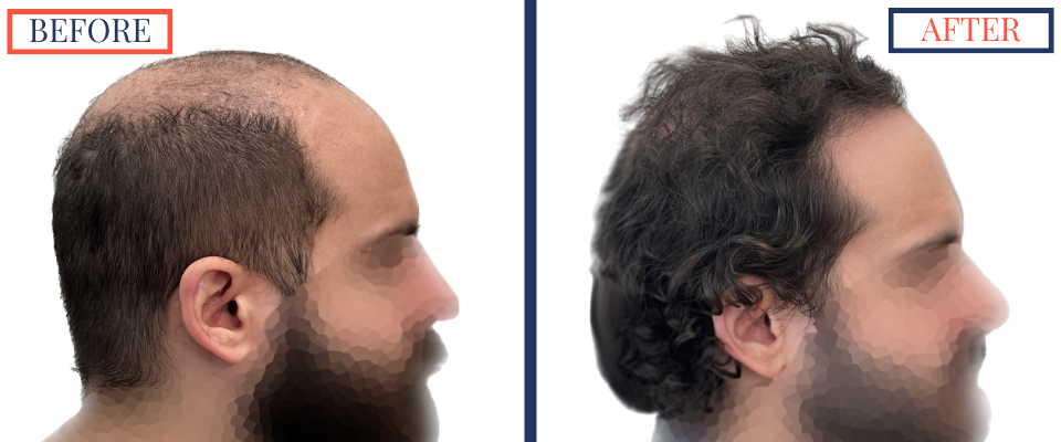 2623 graft FUE hair transplant result
