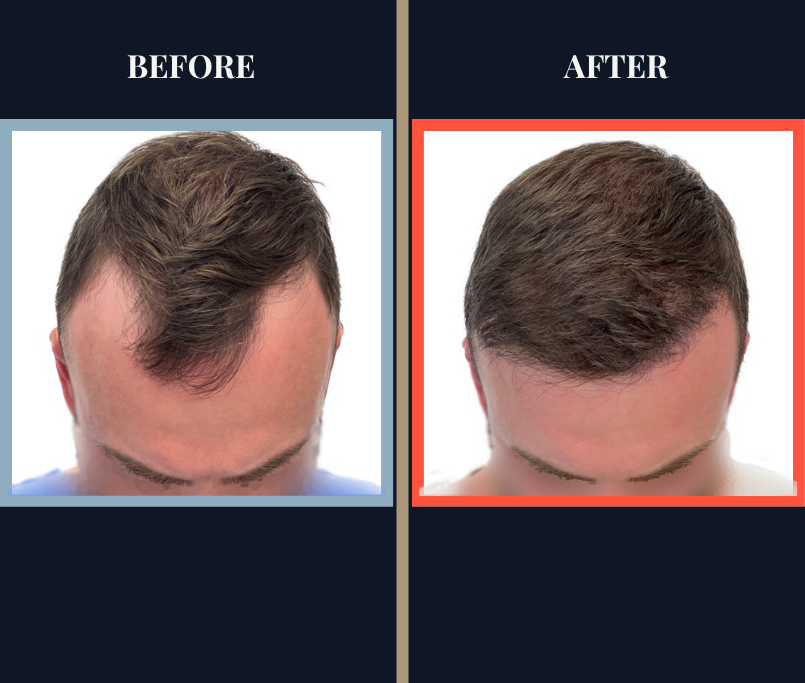 Before and After FUE Hair Transplant Result - 2731 grafts one year post-op
