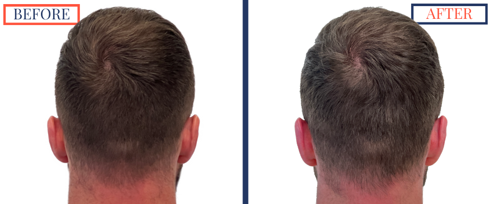 Before and After FUE Hair Transplant Result - 2731 grafts one year post-op