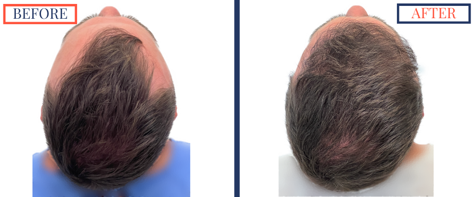 Before and After FUE Hair Transplant Result - 2731 grafts one year post-op