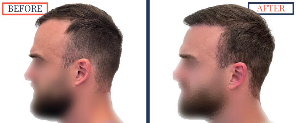 Before and After FUE Hair Transplant Result - 2731 grafts one year post-op