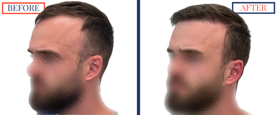 Before and After FUE Hair Transplant Result - 2731 grafts one year post-op