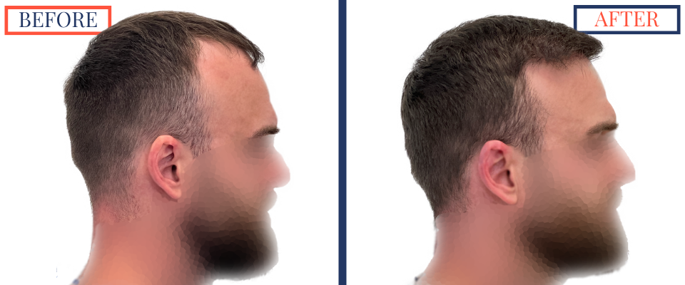 Before and After FUE Hair Transplant Result - 2731 grafts one year post-op