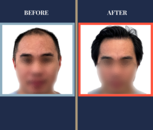 2104 GRAFT FUE HAIR TRANSPLANT RESULT FEATURE IMAGE