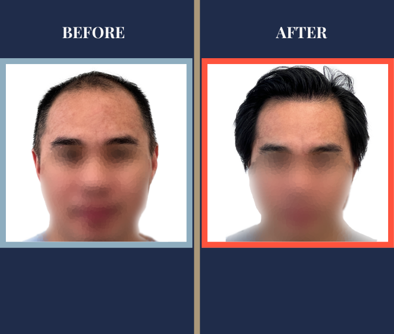 2104 GRAFT FUE HAIR TRANSPLANT RESULT FEATURE IMAGE