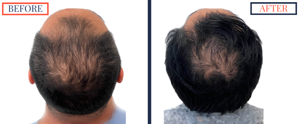 2104 GRAFT FUE HAIR TRANSPLANT RESULT PHOTO