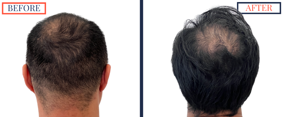 2104 GRAFT FUE HAIR TRANSPLANT RESULT PHOTO