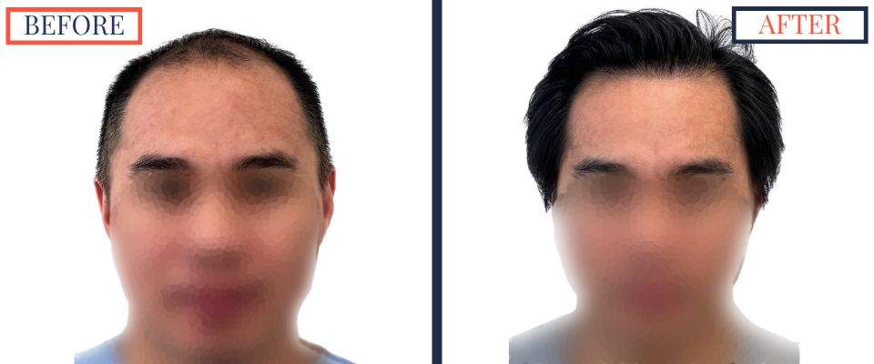 2104 GRAFT FUE HAIR TRANSPLANT RESULT PHOTO
