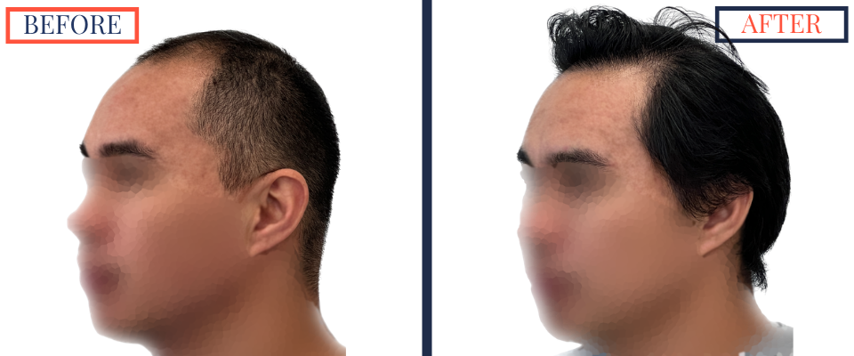 2104 GRAFT FUE HAIR TRANSPLANT RESULT PHOTO