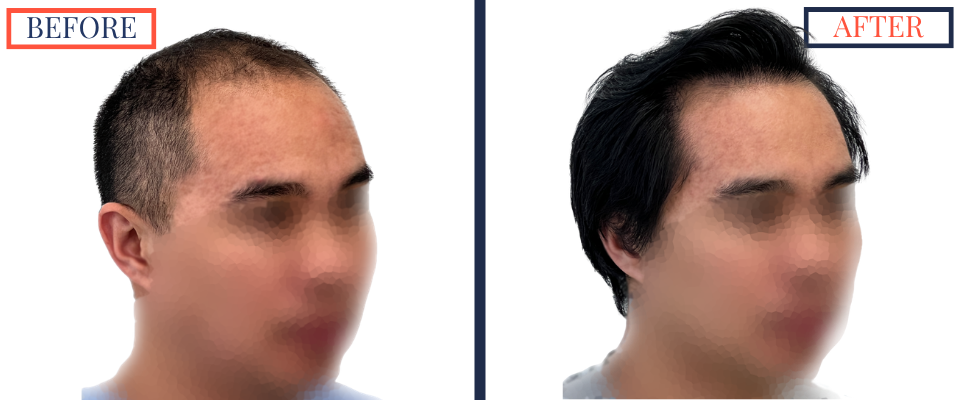 2104 GRAFT FUE HAIR TRANSPLANT RESULT PHOTO