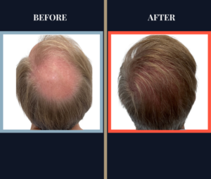 Before and After 1420 graft FUT hair transplant surgical results