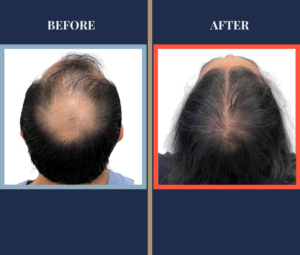 2854 GRAFT FUT HAIR TRANSPLANT - CROWN - RESULTS