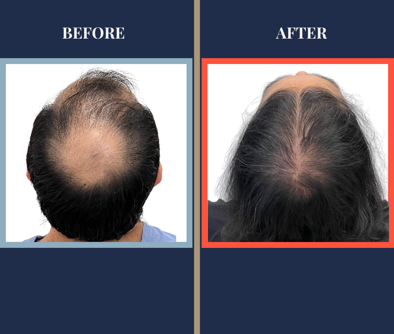 2854 GRAFT FUT HAIR TRANSPLANT - CROWN - RESULTS